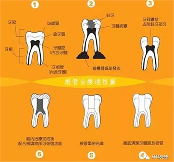 補(bǔ)牙不做冠，療效少一半！根管治療后牙齒已經(jīng)不疼了，為什么還要戴牙冠呢？