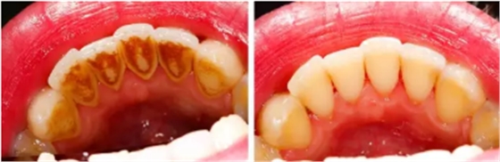 為什么洗牙后還要做牙周刮治？