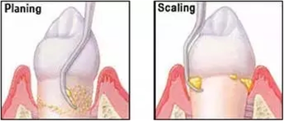 為什么洗牙后還要做牙周刮治？