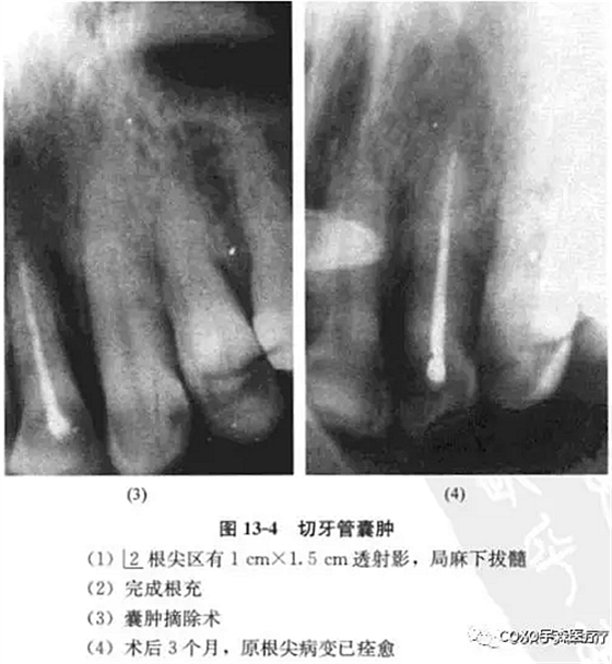 根尖周病的鑒別診斷