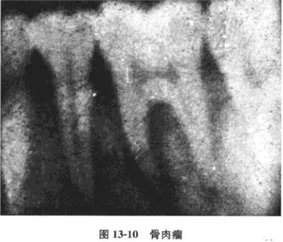 根尖周病的鑒別診斷