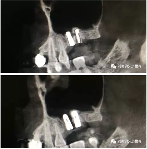 失敗上頜竇種植患者的補(bǔ)救