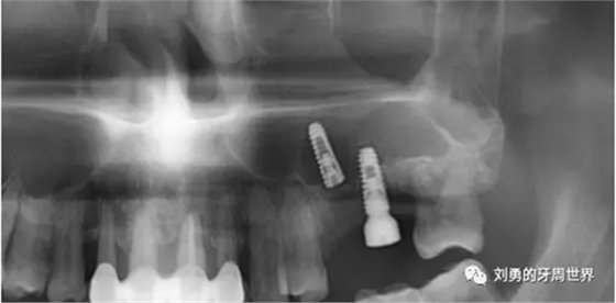 失敗上頜竇種植患者的補(bǔ)救