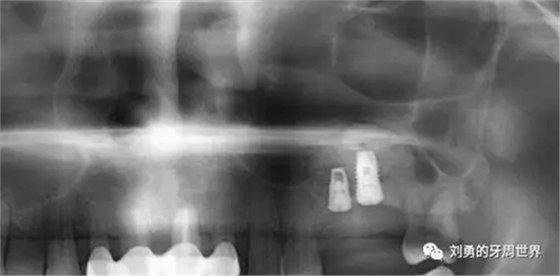 一例失敗上頜竇種植患者的補(bǔ)救