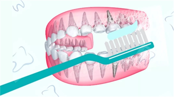 戰(zhàn)“疫”護(hù)牙方法：“坐困家中”，誰(shuí)來(lái)救救我的種植牙？
