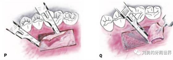 FGG游離牙齦移植在歷史上的各種改良以及發(fā)展前景