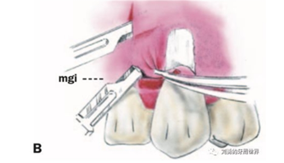 FGG游離牙齦移植在歷史上的各種改良以及發(fā)展前景