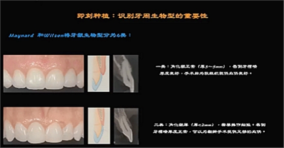 即刻種植的成功要素