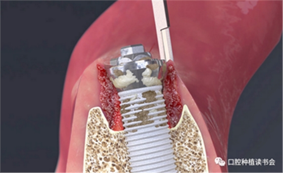 種植體周圍炎的軟硬組織重建治療（上）
