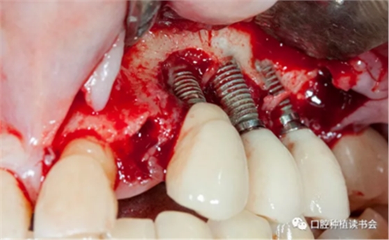 種植體周圍炎的軟硬組織重建治療(下)