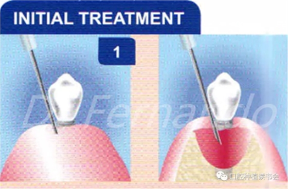 種植體周圍炎的軟硬組織重建治療(下)