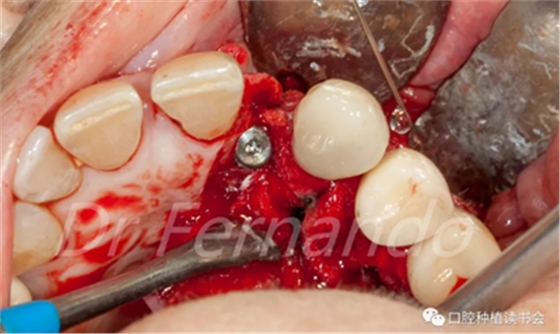 種植體周圍炎的軟硬組織重建治療(下)
