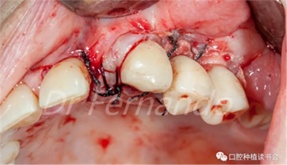 種植體周圍炎的軟硬組織重建治療(下)