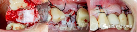 種植體周圍炎的軟硬組織重建治療(下)