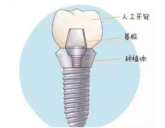 最詳細(xì)的種植牙流程
