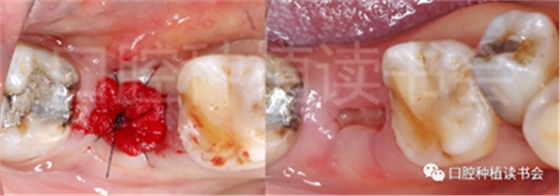 后牙區(qū)即刻種植臨床指南