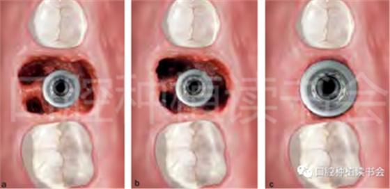 后牙區(qū)即刻種植臨床指南