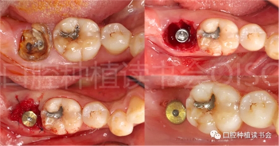 后牙區(qū)即刻種植臨床指南