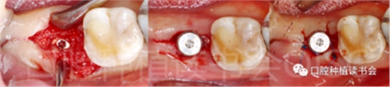 后牙區(qū)即刻種植臨床指南g