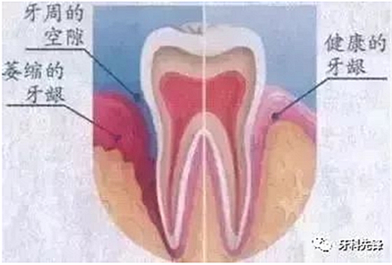 	牙齦萎縮是不治之癥？緩解牙齦萎縮5步走！