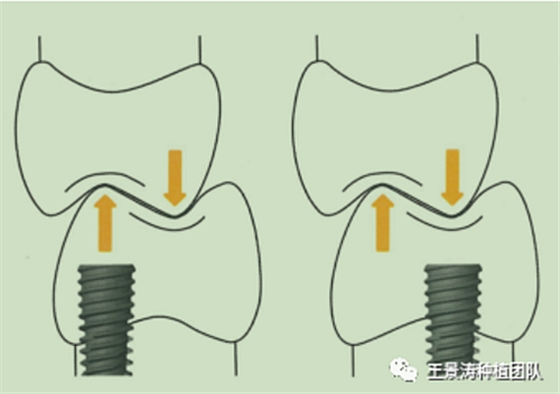 后牙區(qū)即刻種植的適應(yīng)癥的思考