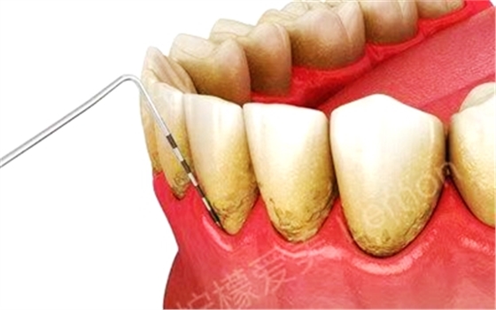 牙周病總是來勢洶洶？有辦法預(yù)防嗎？