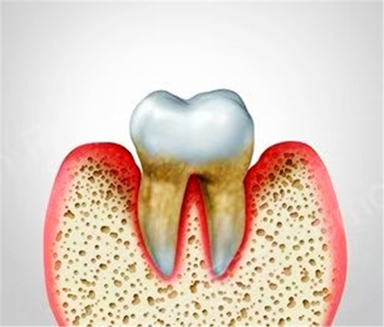 牙周病總是來勢洶洶？有辦法預(yù)防嗎？