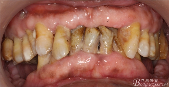 重度牙周炎的咬合重建修復(fù)兩年后效果－－塘沽牙醫(yī)吳世超