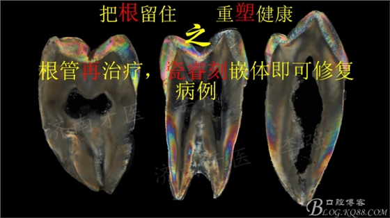 根管再治療，高嵌體即可修復(fù)（濟南牙醫(yī)~ 李強）