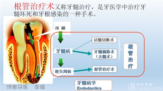 根管再治療，高嵌體即可修復(fù)（濟南牙醫(yī)~ 李強）