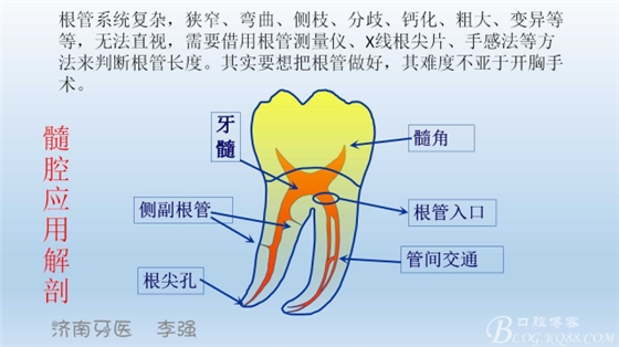 根管再治療，高嵌體即可修復(fù)（濟南牙醫(yī)~ 李強）