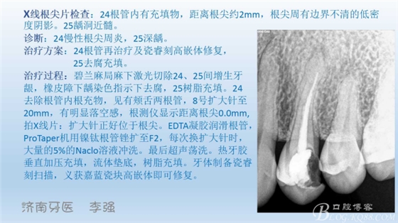 根管再治療，高嵌體即可修復(fù)（濟南牙醫(yī)~ 李強）