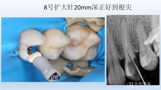 根管再治療，高嵌體即可修復(fù)（濟南牙醫(yī)~ 李強）