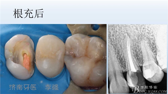 根管再治療，高嵌體即可修復(fù)（濟南牙醫(yī)~ 李強）