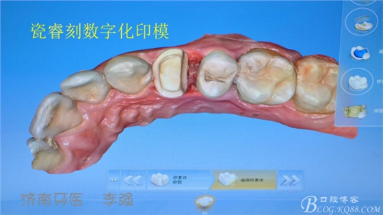 根管再治療，高嵌體即可修復(fù)（濟南牙醫(yī)~ 李強）