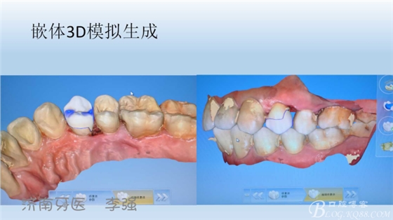 根管再治療，高嵌體即可修復(fù)（濟南牙醫(yī)~ 李強）