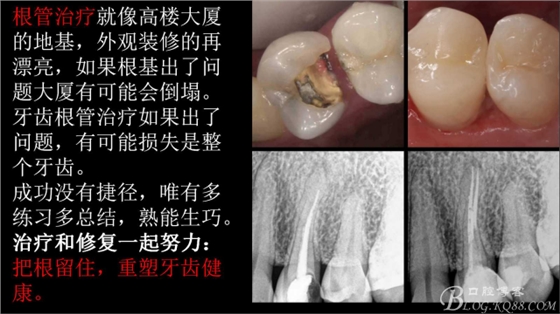 根管再治療，高嵌體即可修復(fù)（濟南牙醫(yī)~ 李強）