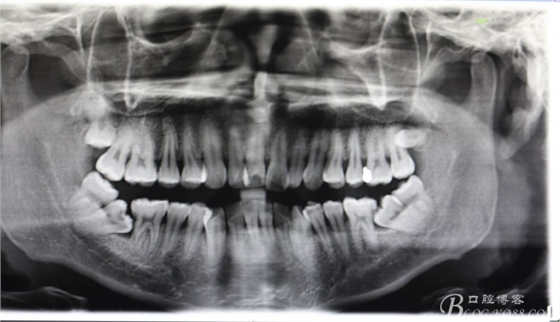 雙側(cè)下頜第二磨牙阻生牙的微創(chuàng)拔除