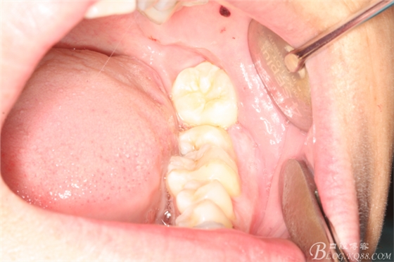 雙側(cè)下頜第二磨牙阻生牙的微創(chuàng)拔除