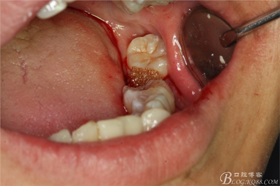 雙側(cè)下頜第二磨牙阻生牙的微創(chuàng)拔除