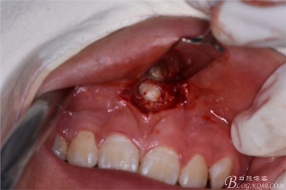 雙切口拔除鼻底埋伏多生牙