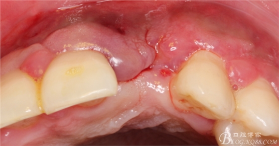 一例上前牙種植失敗病例的補(bǔ)救（梁光強(qiáng)）