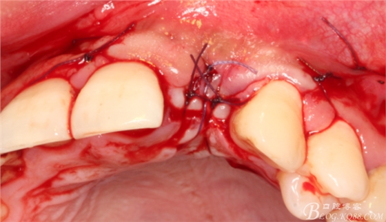 一例上前牙種植失敗病例的補(bǔ)救（梁光強(qiáng)）