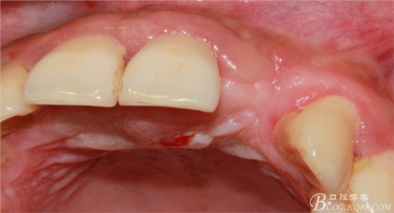 一例上前牙種植失敗病例的補(bǔ)救（梁光強(qiáng)）