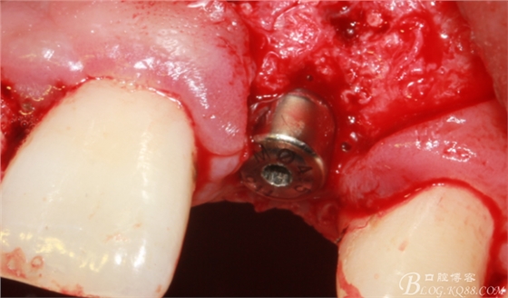 一例上前牙種植失敗病例的補(bǔ)救（梁光強(qiáng)）