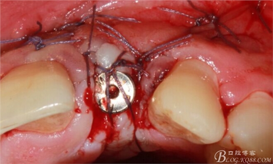 一例上前牙種植失敗病例的補(bǔ)救（梁光強(qiáng)）