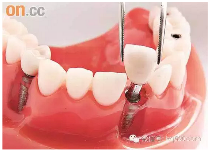 有關(guān)種植牙的一些常見問題問答