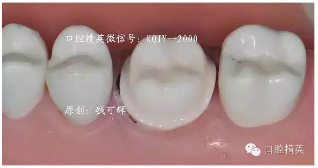 為什么你的牙齒備不好