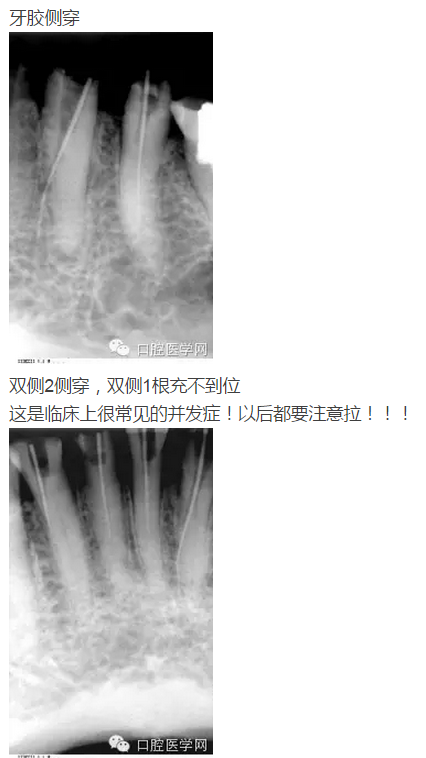 幾張失敗的根管治療x線診斷