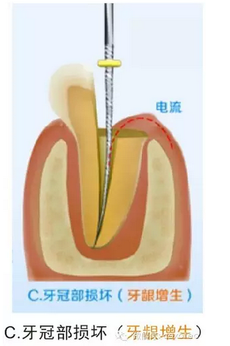 讓你知道根管測量受影響的原因